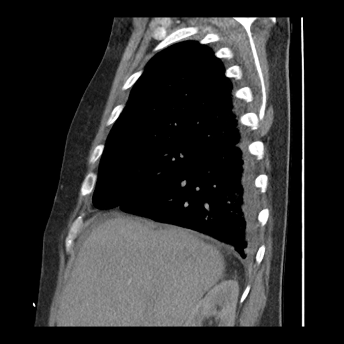 Aortic arch graft infection (FDG PET-CT) (Radiopaedia 71975-82437 C 15).jpg