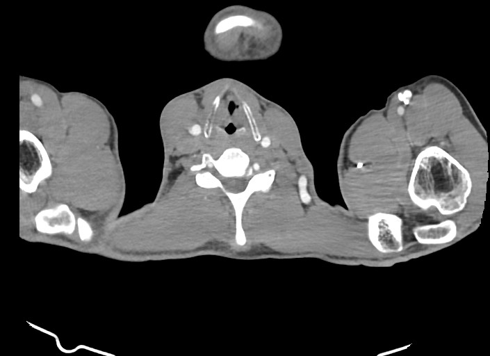File:Aortic coarctation with aneurysm (Radiopaedia 74818-85828 A 201).jpg