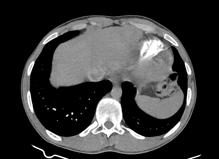 File:Aortic coarctation with aneurysm (Radiopaedia 74818-85828 A 53).jpg
