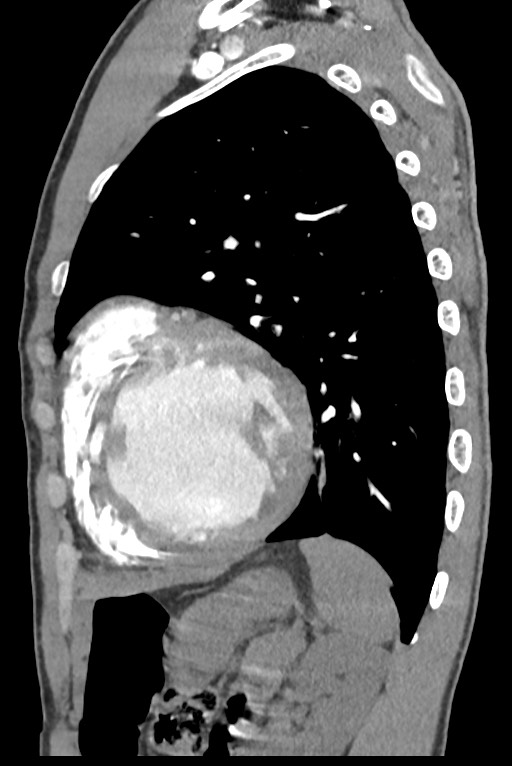 Aortic coarctation with aneurysm (Radiopaedia 74818-85828 B 118).jpg