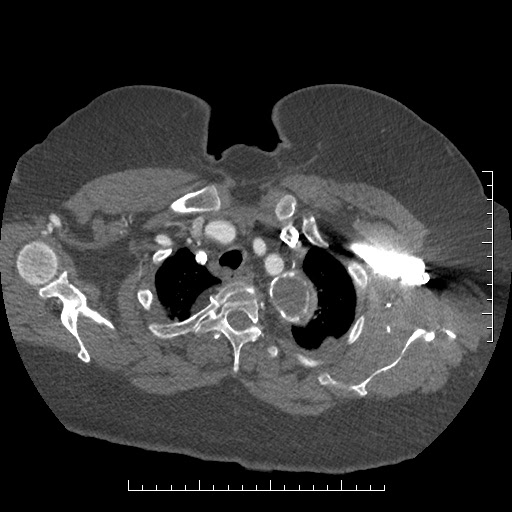 Aortic dissection- Stanford A (Radiopaedia 35729-37268 A 5).jpg