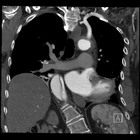 File:Aortic dissection (CTPA) (Radiopaedia 75506-86750 B 41).jpg
