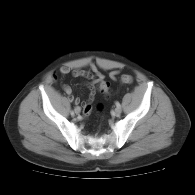 Aortic dissection (Radiopaedia 44411-48061 C 96).jpg