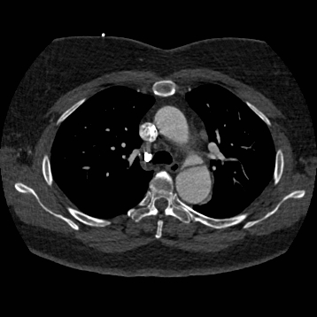 Aortic dissection (Radiopaedia 57969-64959 A 116).jpg
