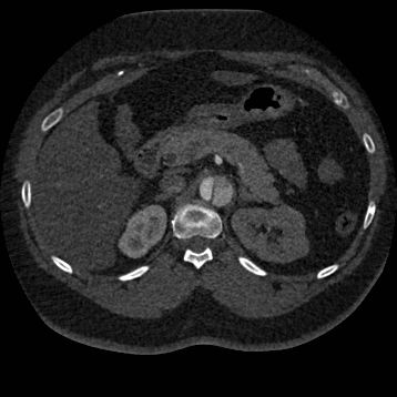 File:Aortic dissection (Radiopaedia 57969-64959 A 350).jpg