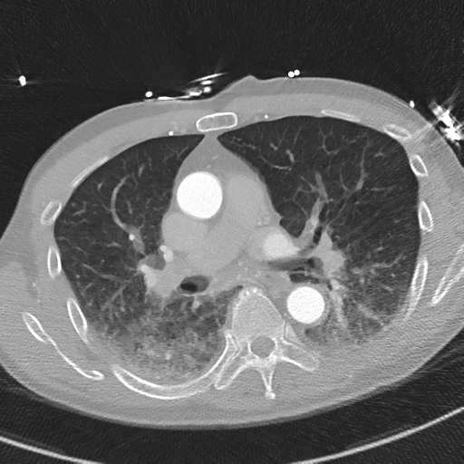 Aortic dissection - DeBakey type II (Radiopaedia 64302-73082 Axial lung window 28).png