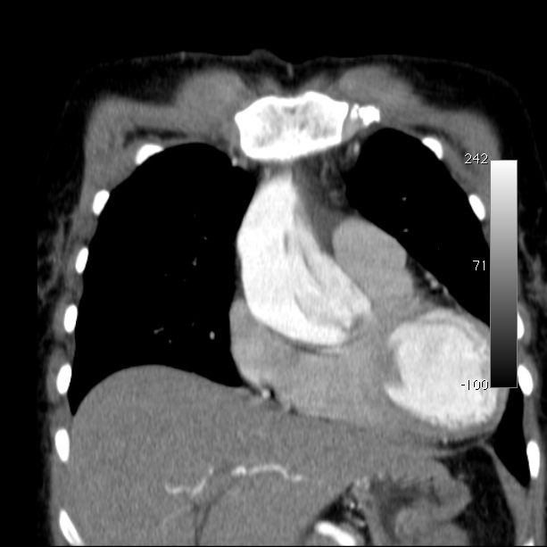 Aortic dissection - Stanford type A (Radiopaedia 29247-29659 B 19).jpg