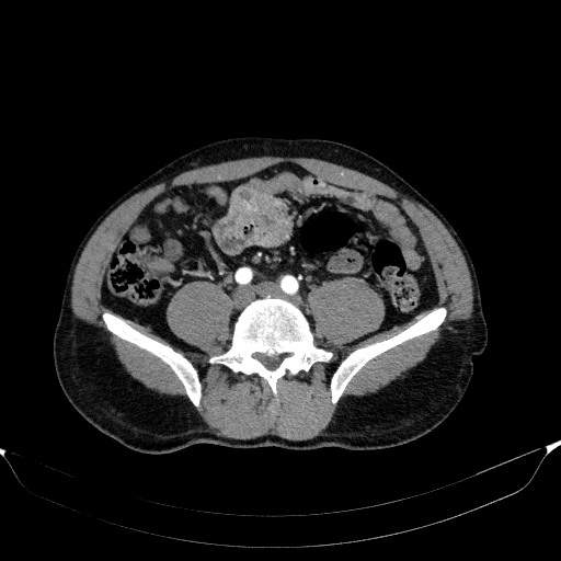 File:Aortic dissection - Stanford type A (Radiopaedia 83418-98500 A 94).jpg