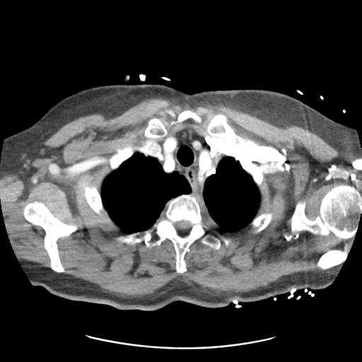 File:Aortic dissection - Stanford type B (Radiopaedia 50171-55512 A 7).png