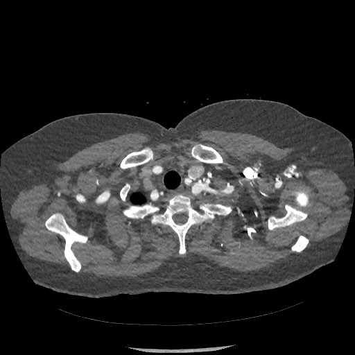 Aortic dissection - Stanford type B (Radiopaedia 88281-104910 A 4).jpg