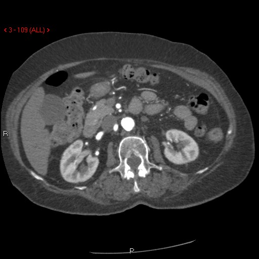 Aortic intramural hematoma (Radiopaedia 27746-28001 A 109).jpg