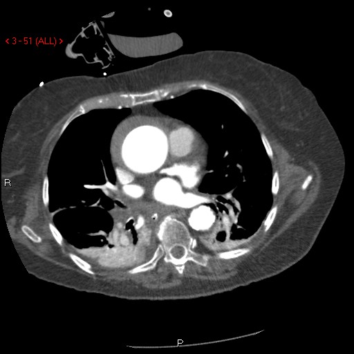 File:Aortic intramural hematoma (Radiopaedia 27746-28001 A 51).jpg