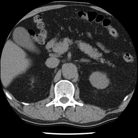 Aortic intramural hematoma (type B) (Radiopaedia 79323-92387 Axial non-contrast 61).jpg