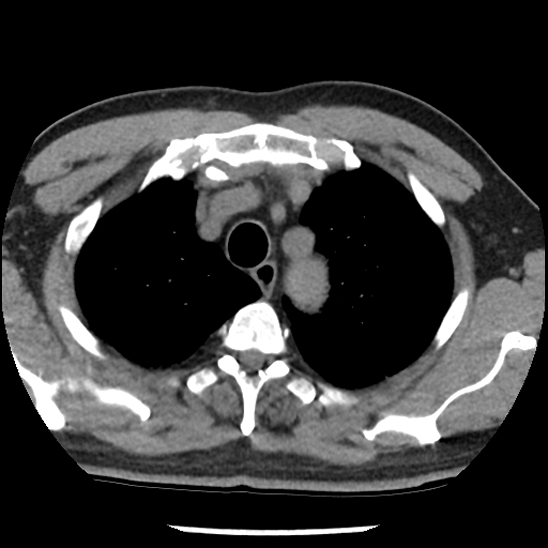 Aortic intramural hematoma (type B) (Radiopaedia 79323-92387 Axial non-contrast 8).jpg