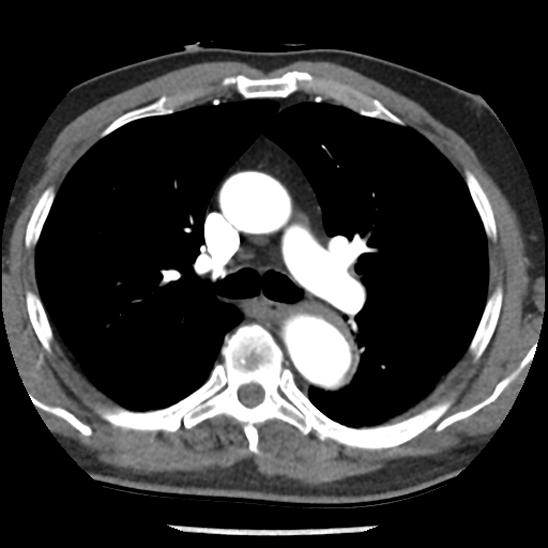 Aortic intramural hematoma (type B) (Radiopaedia 79323-92387 B 20).jpg