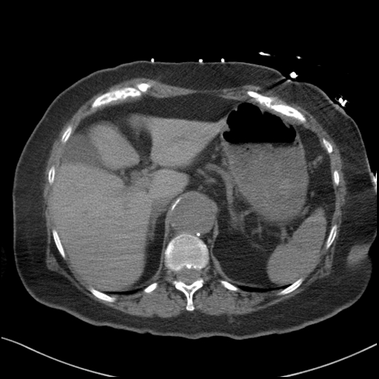 Aortic intramural hematoma with dissection and intramural blood pool (Radiopaedia 77373-89491 Axial non-contrast 96).jpg