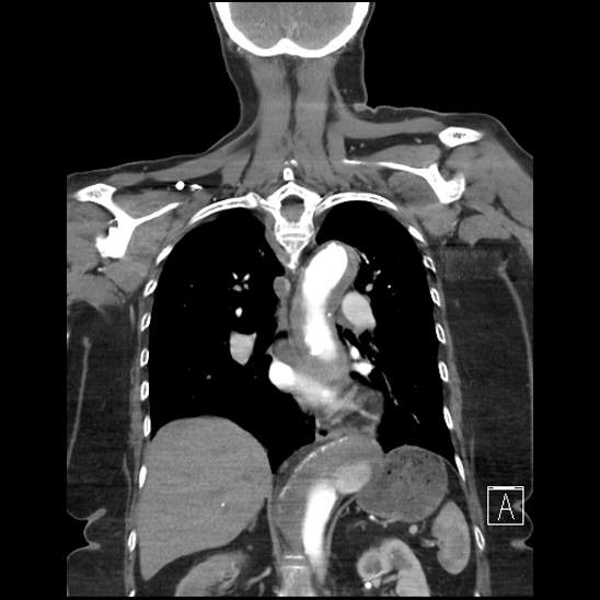 Aortic intramural hematoma with dissection and intramural blood pool (Radiopaedia 77373-89491 C 40).jpg