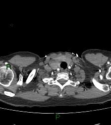 File:Aortic valve endocarditis (Radiopaedia 87209-103485 C 4).jpg