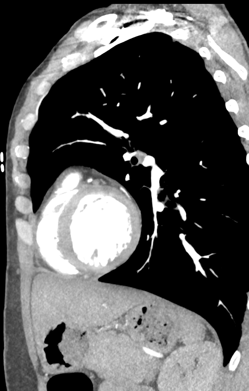Aortic valve non-coronary cusp thrombus (Radiopaedia 55661-62189 C+ arterial phase 15).png