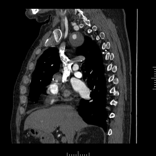 File:Aorto-coronary bypass graft aneurysms (Radiopaedia 40562-43157 C 11).png