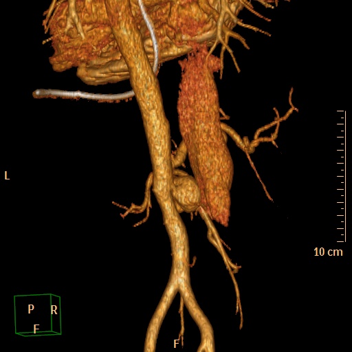 File:Aorto-left renal vein fistula (Radiopaedia 45534-49628 D 34).jpg