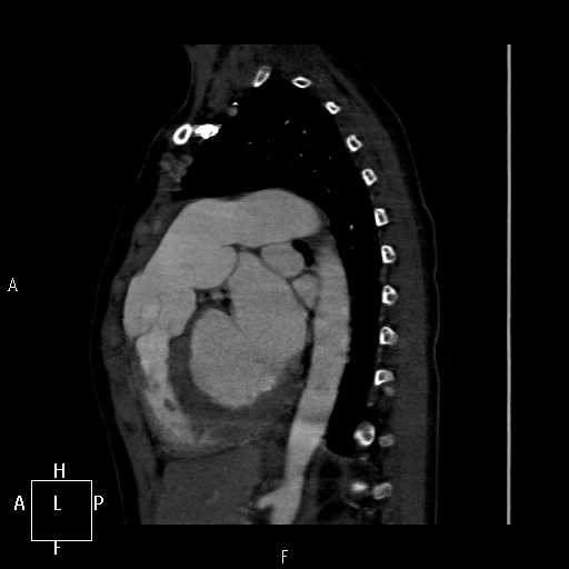 File:Aortopulmonary septal defect (Radiopaedia 41990-45013 Sagittal C+ CTPA 17).jpg