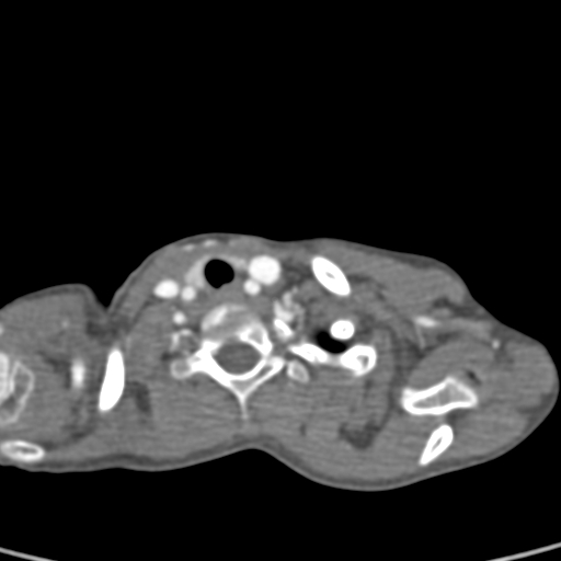 File:Aortopulmonary window, interrupted aortic arch and large PDA giving the descending aorta (Radiopaedia 35573-37074 B 3).jpg