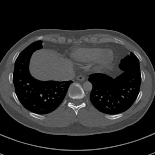 Apical lung mass mimic - neurogenic tumor (Radiopaedia 59918-67521 Axial bone window 64).jpg