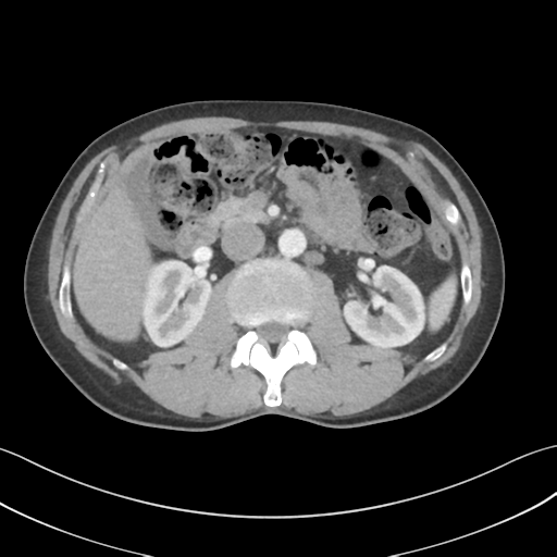 File:Apical pleural calcification (Radiopaedia 46141-50499 Axial C+ delayed 82).png