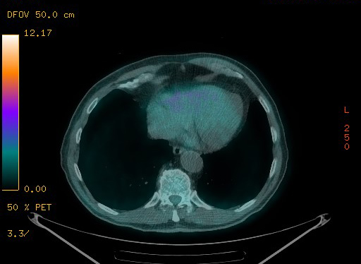 Appendiceal adenocarcinoma complicated by retroperitoneal abscess (Radiopaedia 58007-65041 Axial PET-CT 94).jpg