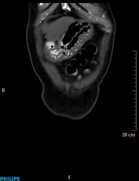 Appendiceal mucocoele (Radiopaedia 29449-29917 E 61).jpg