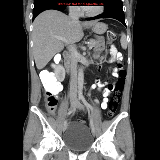 File:Appendicitis and renal cell carcinoma (Radiopaedia 17063-16760 B 15).jpg