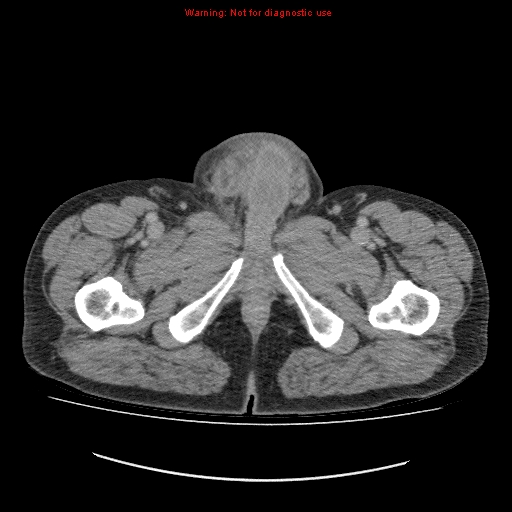 File:Appendicitis mass in inguinal hernia (Radiopaedia 26858-27029 A 39).jpg