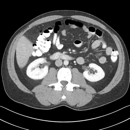 File:Appendicitis with cecal bar sign (Radiopaedia 31878-32830 B 38).jpg