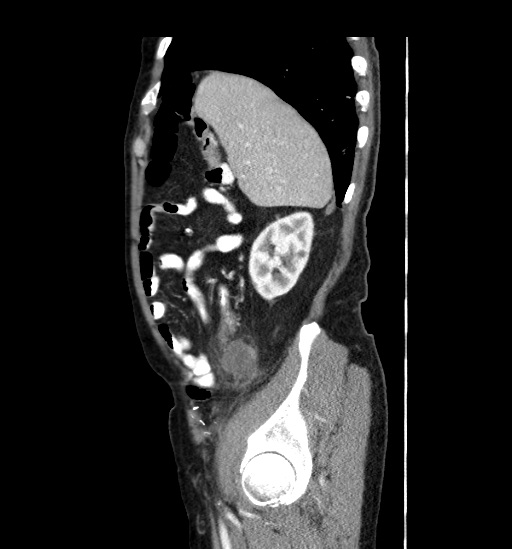 Appendicitis with localized perforation and abscess formation (Radiopaedia 49035-54130 C 15).jpg