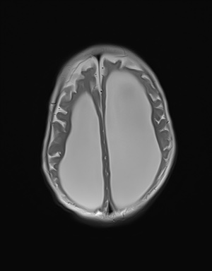 File:Aqueductal stenosis (Radiopaedia 73974-84802 Axial T2 17).jpg