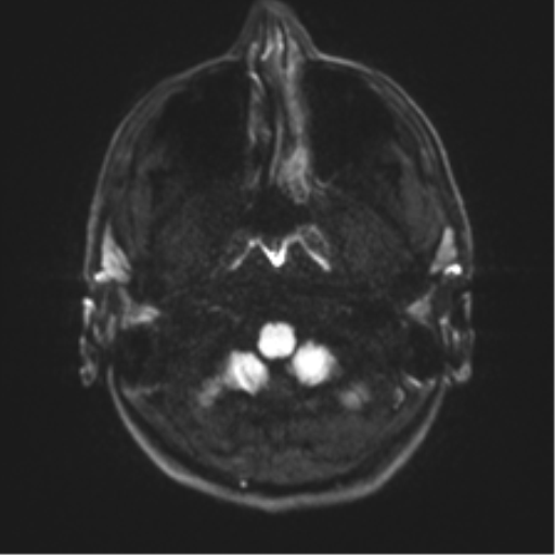 Arachnoid cyst - cerebellopontine angle (Radiopaedia 59689-67083 Axial DWI 39).png