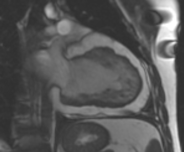 Arrhythmogenic right ventricular cardiomyopathy (Radiopaedia 69431-79307 2ch cine 23).jpg