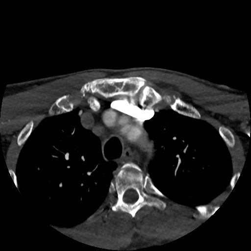 Artery of Percheron infarct (Radiopaedia 48088-52894 A 10).jpg