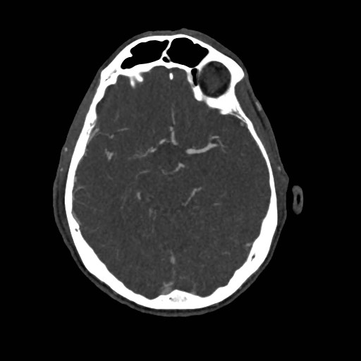 File:Artery of Percheron infarct (Radiopaedia 48088-52894 A 130).jpg