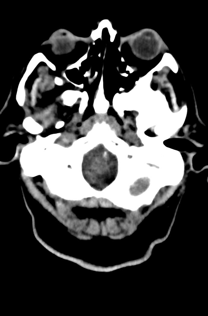 Artery of Percheron infarction (Radiopaedia 80613-94202 Axial non-contrast 32).jpg