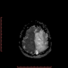 Astroblastoma (Radiopaedia 74287-85162 Axial ADC 63).jpg