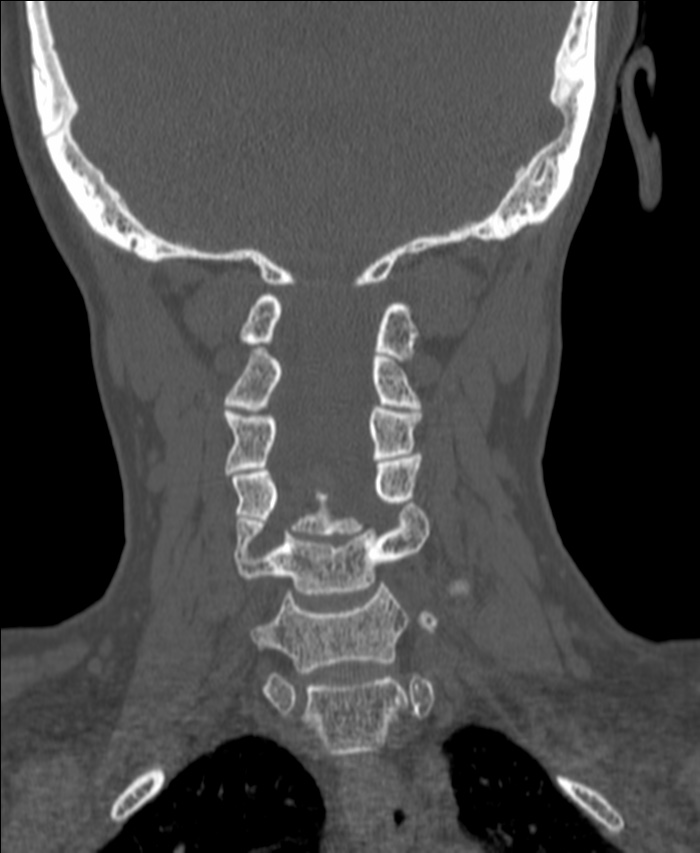 Atlanto-occipital assimilation with basilar invagination (Radiopaedia 70122-80188 Coronal bone window 130).jpg