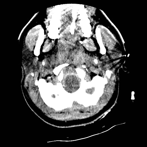 Atlanto-occipital dislocation (Radiopaedia 44648-48412 Axial non-contrast 6).jpg