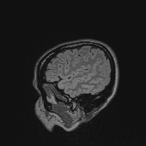 Atretic encephalocoele with inferior vermis hypoplasia (Radiopaedia 30443-31108 Sagittal FLAIR 35).jpg