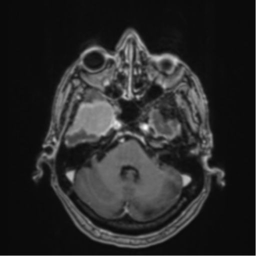 Atypical meningioma (WHO Grade II) (Radiopaedia 54742-60979 Axial T1 C+ 14).png