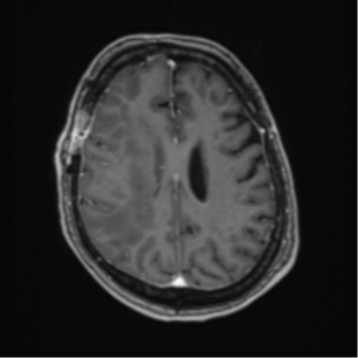 Atypical meningioma (WHO Grade II) (Radiopaedia 54742-60981 Axial T1 C+ 48).png