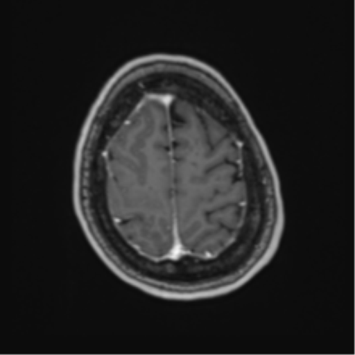 Atypical meningioma (WHO Grade II) (Radiopaedia 54742-60981 Axial T1 C+ 60).png