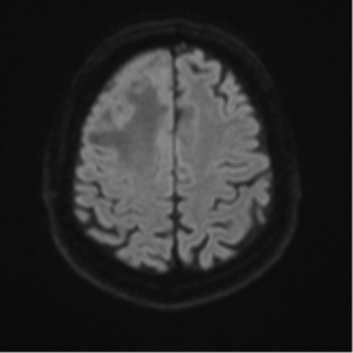 File:Atypical meningioma (WHO grade II) with brain invasion (Radiopaedia 57767-64729 Axial DWI 53).png