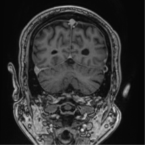 Atypical meningioma (WHO grade II) with brain invasion (Radiopaedia 57767-64729 Coronal T1 C+ 67).png